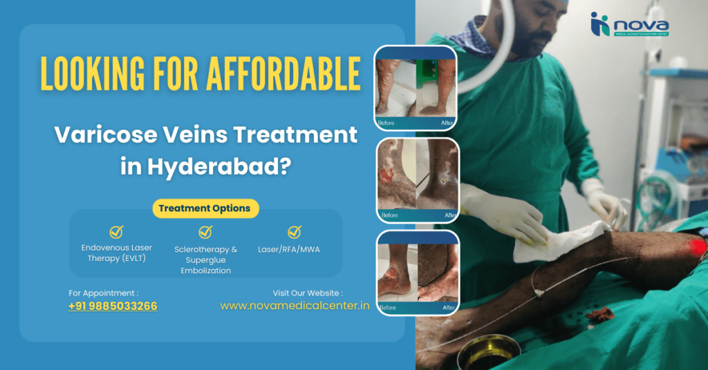 affordable-varicose-veins-treatment-hyderabad