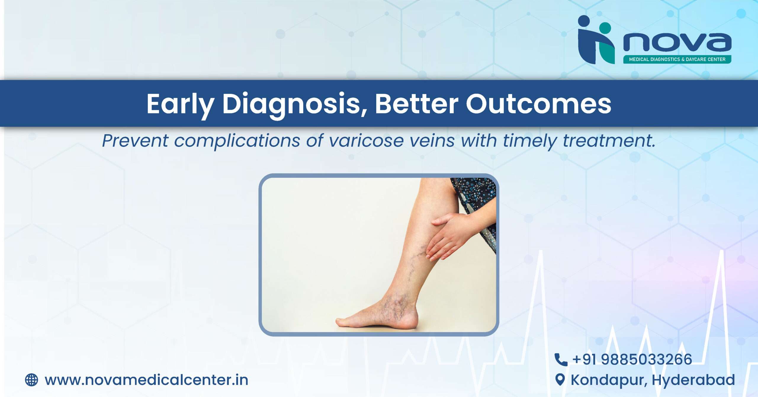 varicose-veins-treatment-kondapur-nova-medical-centre