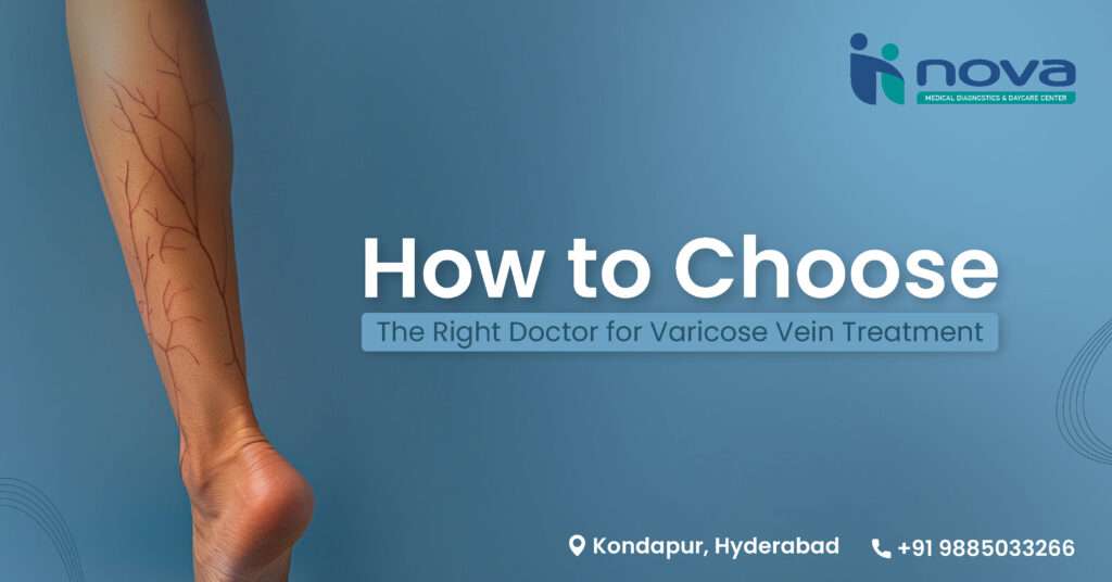 how-to-choose-right-doctor-for-varicose-veins-treatment-kondapur-hyderabad